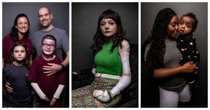 Debra Lee Scott: Unveiling the Heart of Support for Epidermolysis Bullosa at Debra of America